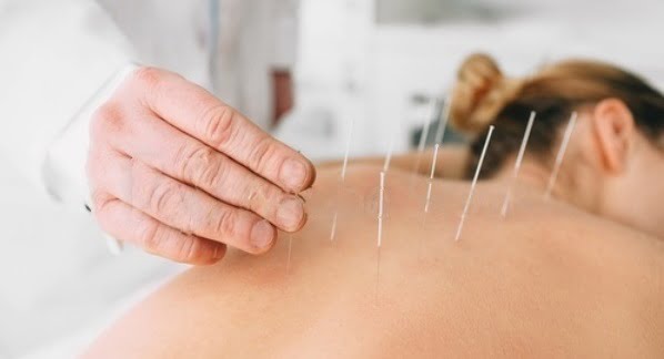 When do Chiropractors use Acupuncture?