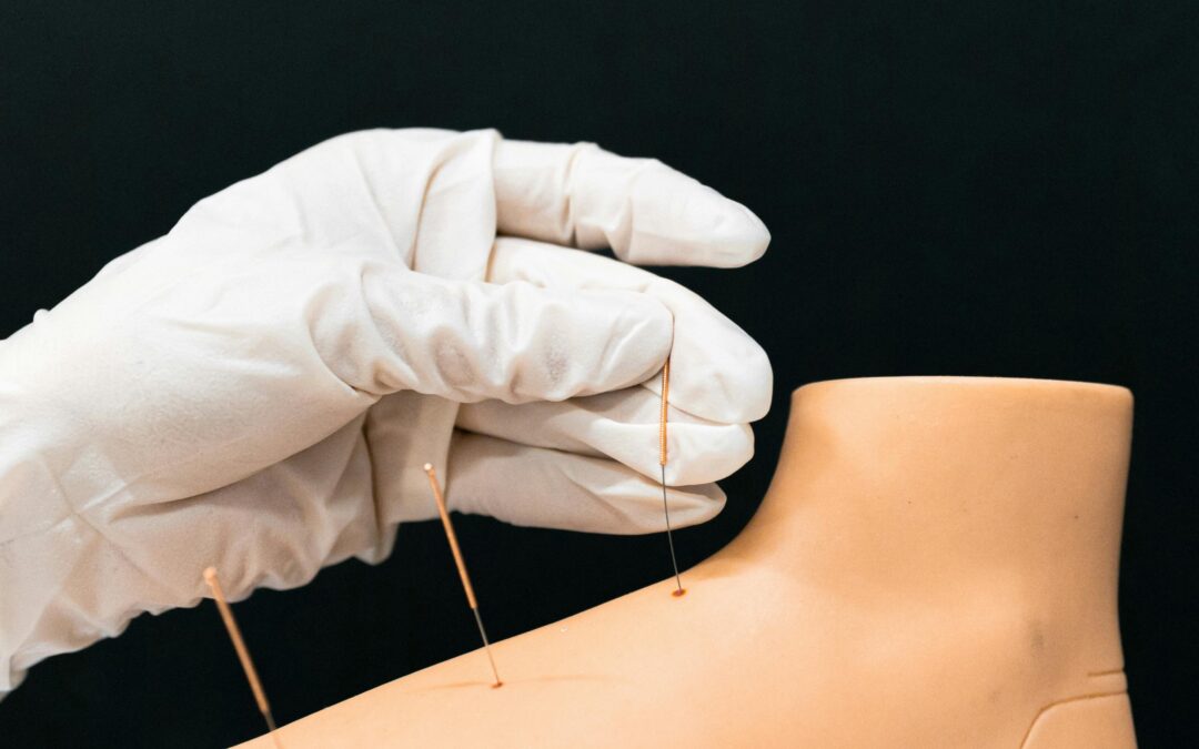 Acupuncture Kitchener